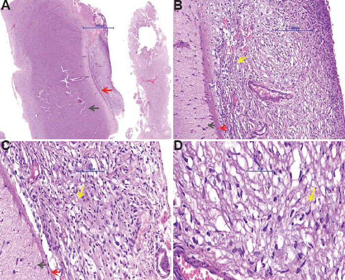 Piamater with cortex biopsy specimen slide (A, H and E, ×2; B, H and E, ×10 and C, H and E, ×20) showing cortical normal brain parenchyma shown with black arrow, pial gliosis shown with red arrow, blood vessels shown with grey arrow and elongated tumour cells shown with yellow arrow. (D) Tumour area with low-to-moderate cellularity composed of elongated cells shown with yellow arrow and a few clear cells. Mitosis was not seen (H and E, ×40).